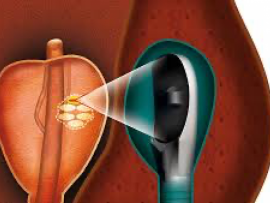 علاج جديد واعد لسرطان البروستات!