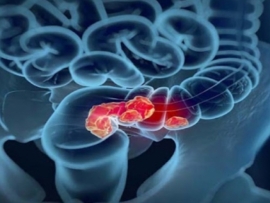 علماء كوريون يحولون خلايا سرطان القولون إلى خلايا طبيعية